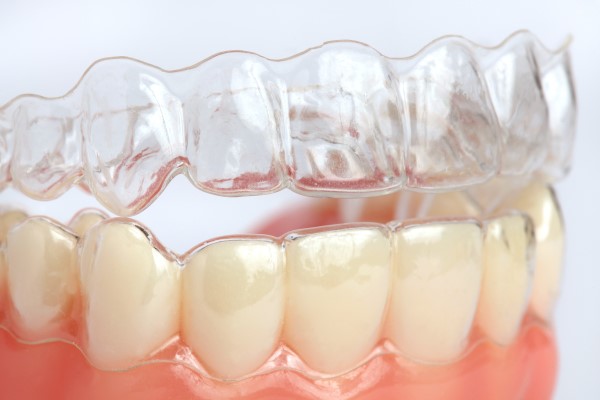 Questions To Ask An Invisalign Dentist