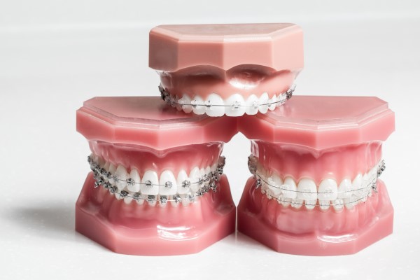 When Is Early Orthodontics Necessary?